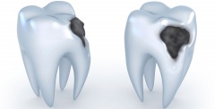 Кариес зубов - причины, симптомы, лечение и профилактика